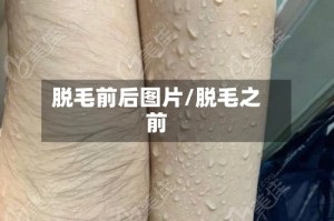脱毛前后图片/脱毛之前