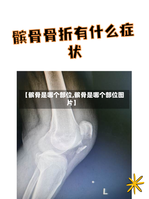 【髌骨是哪个部位,髌骨是哪个部位图片】-第1张图片